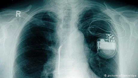 دل کے مریضوں کے لیے نئی امید: بیٹری کے بغیر پہلا پیس میکر
