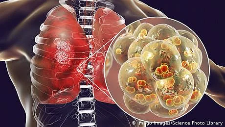 نمونیا: علاج موجود مگر پر بھی مہلک ترین مرض