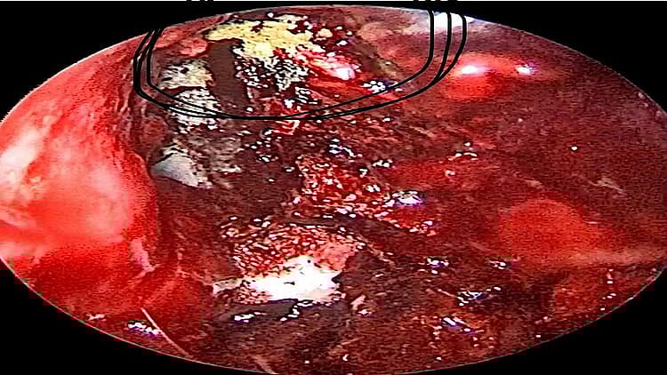 پہلے بلیک، پھر وہائٹ، اور اب ’یلو فنگس‘ سے دہشت، یو پی میں ملا پہلا مریض