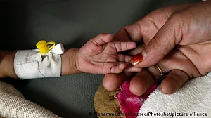 غذائی قلت کے شکار بچوں کے لیے صورت حال تباہ کن، اقوام متحدہ