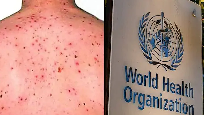 منکی پاکس / علامتی تصویر