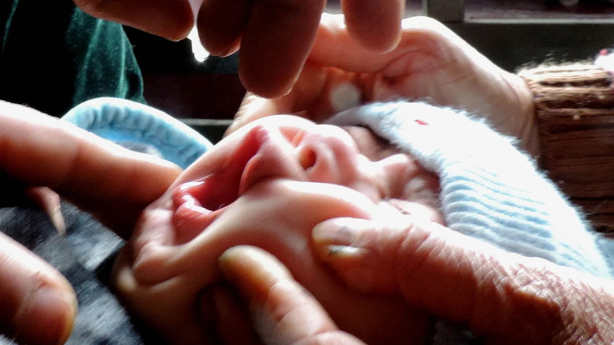 پولیو، علامتی تصویر یو این آئی