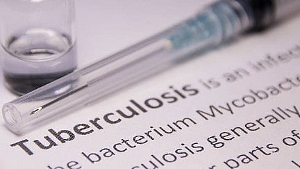 ہندوستان میں تپ دق کے نئے مریضوں میں21 فیصد کمی