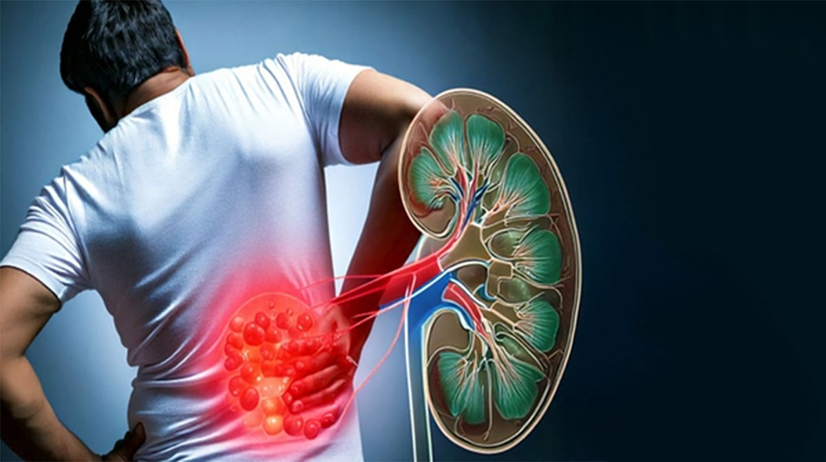 یورین میں نمکیات کے بڑھنے سے نوجوانوں میں کڈنی اسٹون کے معاملات میں اضافہ