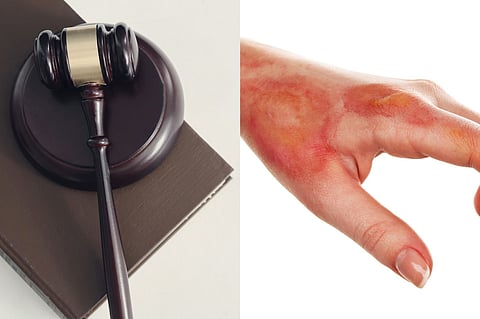 The Seldom Discussed Impact of a Burn Injury on the Victim's Self-Esteem