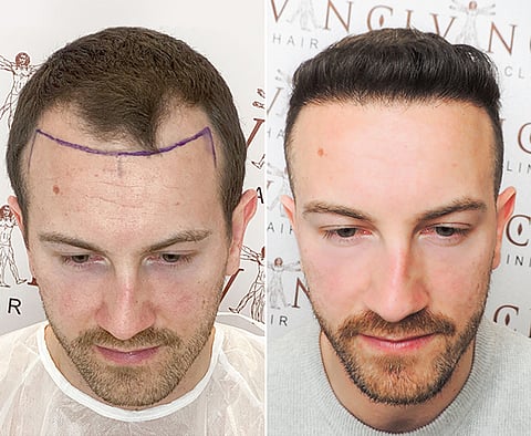 a hair transplant procedure before and after