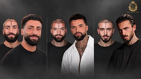 Three men before and after hair transplants.