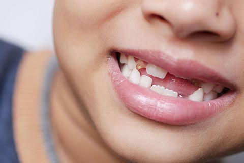 Child smiling with missing teeth.