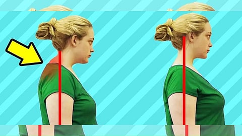 Neck Hump