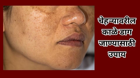 Home Remedies On Pigmentation