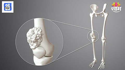 Bone cancer symptoms