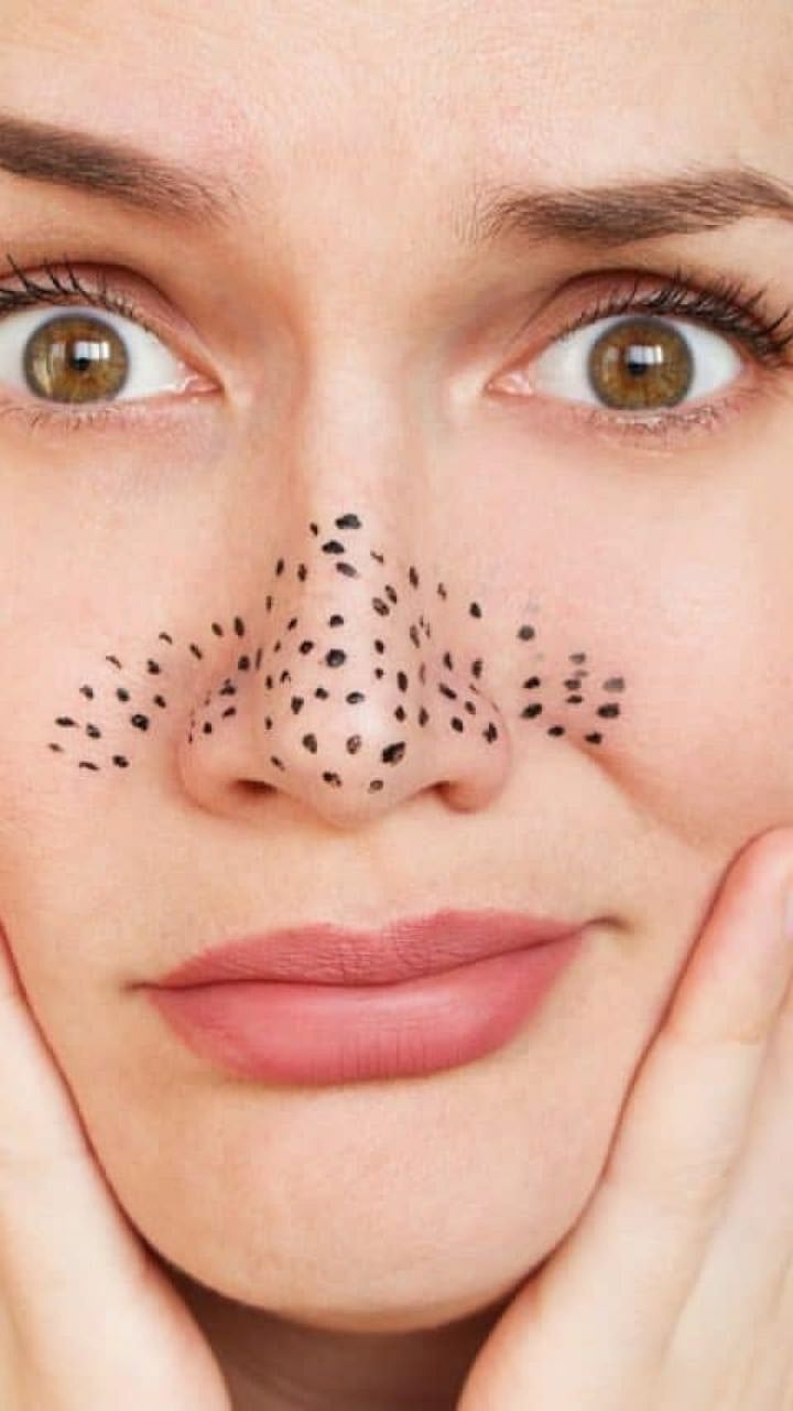 Blackheads: चेहऱ्यावरील ब्लॅकहेड्स होतील गायब, स्कीन करेल ग्लो; फक्त ...