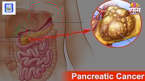 Early symptoms of pancreatic cancer