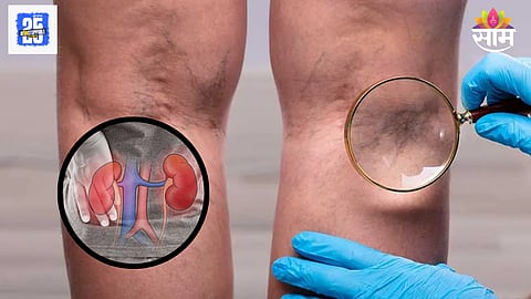 Kidney failure symptoms on legs