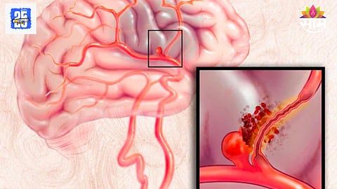 Brain aneurysm