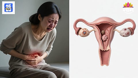 Cause of Ovarian Cancer