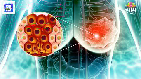 Cancer progression