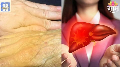 Liver Disease Symptoms
