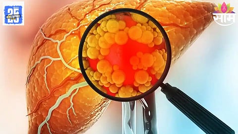 fatty liver remedy