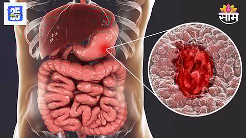 Early stomach cancer warning signs