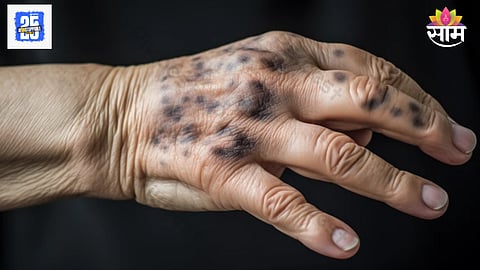 Blood cancer warning symptoms