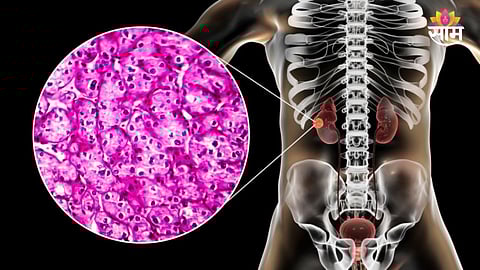 kidney cancer 7 symptoms