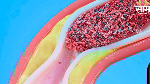 High cholesterol causes