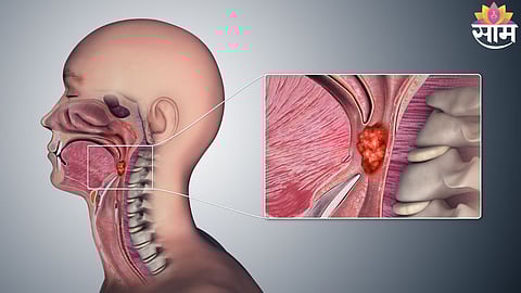 Precision Oncology Treatment in Pune