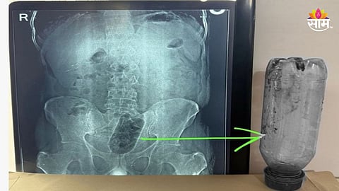 Shocking: लैंगिक विकृतीतून तरुणाने गुदाशयात घुसवली पाण्याची बाटली, ३६ तास असह्य वेदना, १ तासाच्या शस्त्रक्रियेनंतर वाचले प्राण