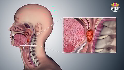 Throat cancer