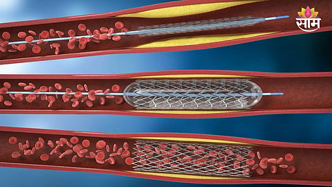 Heart blockage treatment