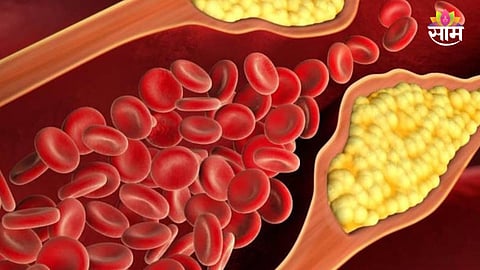 High Cholesterol Warning Signs