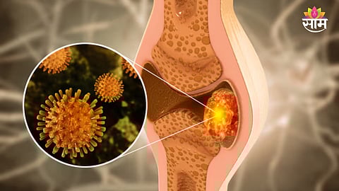 Early signs of bone cancer