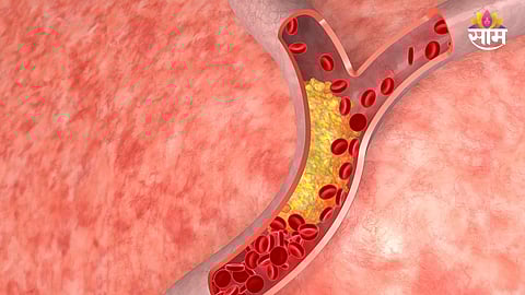 LDL cholesterol increase