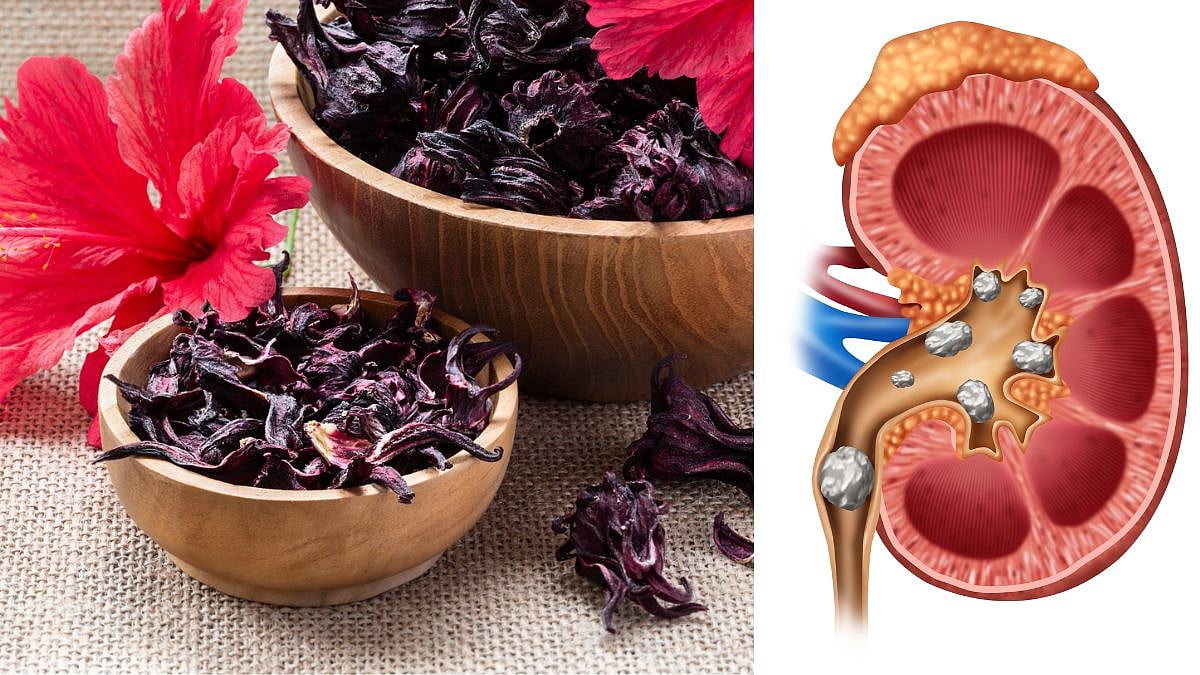 Kidney Stone Problem : मुतखड्याच्या दुखण्यावर जालीम उपाय! फक्त 7 ...