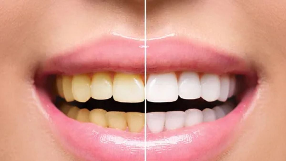Yellow Teeth Cleaning Tips in Marathi दातांचा पिवळेपणा दूर करण्यासाठी