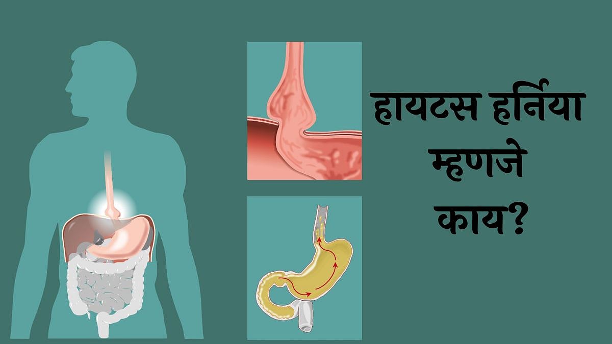 Hiatus Hernias Meaning: हायटस हर्निया म्हणजे काय? याची लक्षणे कोणती ...