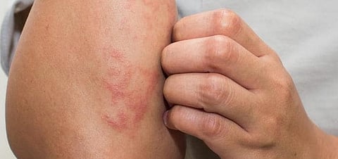 علامات تحذيرية لنقص فيتامين A.. الجلد يكشف عنها بوضوح