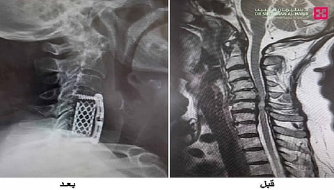 مركز جراحة المخ والأعصاب بمجمع الدكتور سليمان الحبيب بالعليا يُنهي معاناة مسنة بعد جراحة استغرقت 4 ساعات