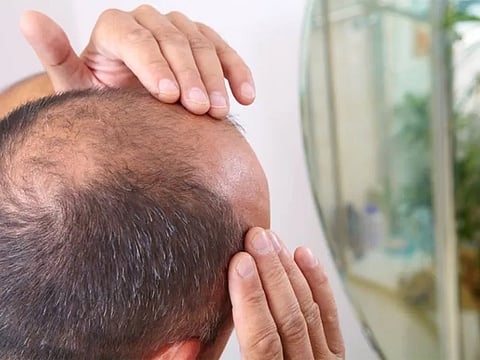 أفضل من العلاجات الطبية.. "جل السكر الطبيعي" يظهر فعالية مدهشة بمحاربة الصلع الوراثي