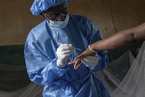 "الصحة العالمية": تسجيل 14.700 حالة إصابة مؤكدة بجدري القردة في إفريقيا