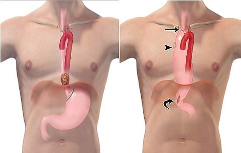 نجاح أول عملية استئصال للمريء لمريض مصاب بالسرطان في مستشفيات المانع بالخُبَر