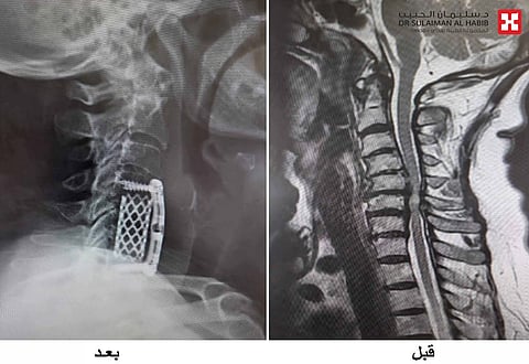 مركز جراحة المخ والأعصاب بمجمع الدكتور سليمان الحبيب بالعُليا يُعيد الحركة لثمانينية وينهي معاناتها مع الآلام