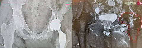 مستشفى الدكتور سليمان الحبيب بالصحافة يُنهي معاناة شاب مع صعوبة المشي والحركة