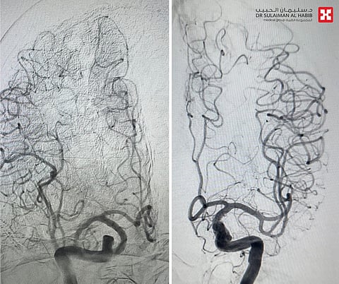 مستشفى الدكتور سليمان الحبيب بالصحافة ينهي معاناة مُسن مع جلطة في الشريان الفقري بالمخيخ دون جراحة