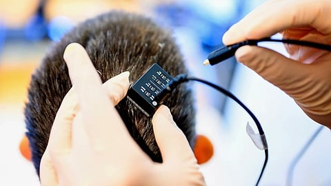  شريحة دماغية تترجم الأفكار إلى كلام فورياً
