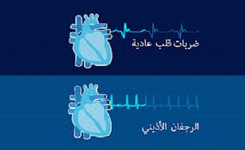 مصنوعة بالذكاء الاصطناعي.. "قلوب رقمية مُتليفة" تساعد في علاج الرجفان الأذيني