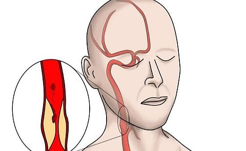 بُشرى لمرضى انسداد شرايين الرقبة.. دراسة: لا جراحة للوقاية من خطر السكتات الدماغية كما يحدث الآن