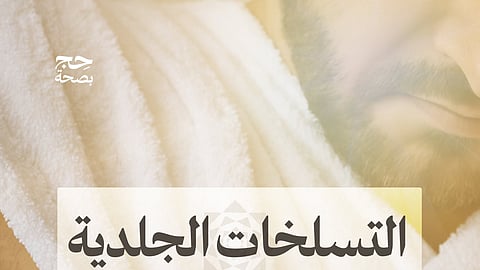 "الصحة" تُحذّر الحجاج من التسلخات الجلدية وتُقدّم إرشادات وقائية لتجنّبها