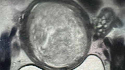 "سعود الطبية" تسجّل قصة نجاح في علاج ألياف الرحم بالقسطرة